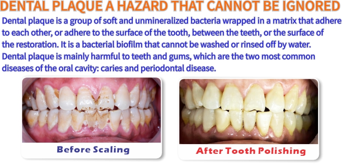 Dental Plaque Hazard