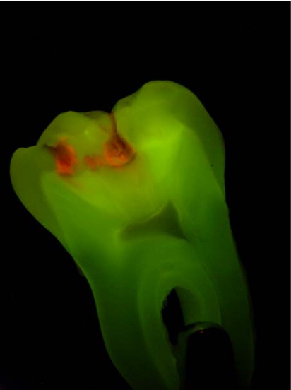 Caries appear orange-red with FACE